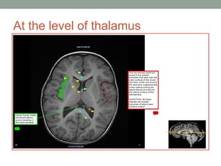 At the level of thalamus
 