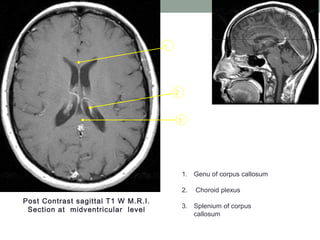3
2
1
Post Contrast sagittal T1 W M.R.I.
Section at midventricular level
1. Genu of corpus callosum
2. Choroid plexus
3. Splenium of corpus
callosum
 