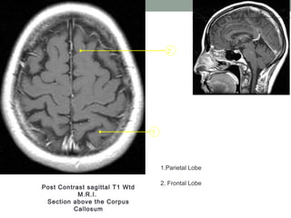 1
2
Post Contrast sagittal T1 Wtd
M.R.I.
Section above the Corpus
Callosum
1.Parietal Lobe
2. Frontal Lobe
 
