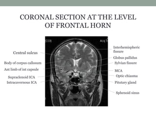 CORONAL SECTION AT THE LEVEL
OF FRONTAL HORN
Intracavernous ICA
Supraclenoid ICA
Pitutary gland
Optic chiasma
Sylvian fissureBody of corpus callosum
Central sulcus
Interhemispheric
fissure
Globus pallidus
Ant limb of int capsule MCA
Sphenoid sinus
 