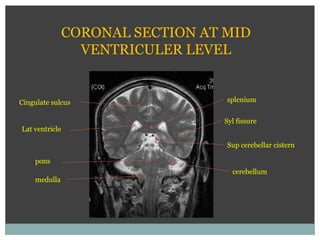 CORONAL SECTION AT MID
VENTRICULER LEVEL
Lat ventricle
Sup cerebellar cistern
Syl fissure
Cingulate sulcus
pons
medulla
cerebellum
splenium
 
