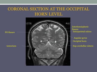 CORONAL SECTION AT THE OCCIPITAL
HORN LEVEL
Occipital horn
Sup cerebellar cistern
PO fissure Interparietal sulcus
tentorium
Interhemispheric
fissure
Angular gyrus
 
