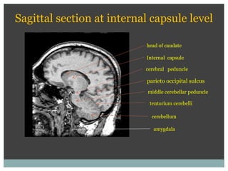 cerebral peduncle
head of caudate
middle cerebellar peduncle
tentorium cerebelli
Sagittal section at internal capsule level
parieto occipital sulcus
Internal capsule
cerebellum
amygdala
 
