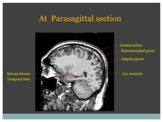 Central sulcus
Lat ventricle
Temporal lobe
Sylvian fissure
At Parasagittal section
Supramarginal gyrus
Angular gyrus
 