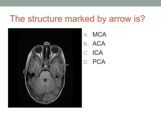 The structure marked by arrow is?
A. MCA
B. ACA
C. ICA
D. PCA
 