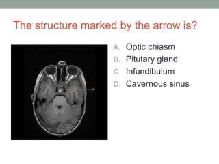 The structure marked by the arrow is?
A. Optic chiasm
B. Pitutary gland
C. Infundibulum
D. Cavernous sinus
 
