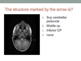 The structure marked by the arrow is?
A. Sup cerebellar
peduncle
B. Middle cp
C. Inferior CP
D. none
 