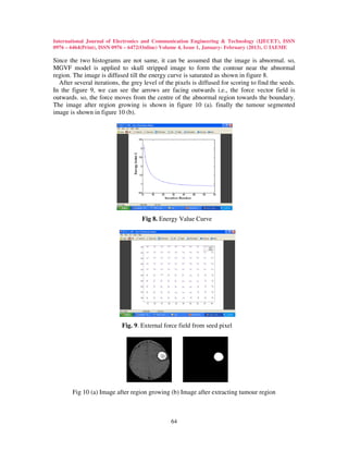 International Journal of Electronics and Communication Engineering & Technology (IJECET), ISSN
0976 – 6464(Print), ISSN 0976 – 6472(Online) Volume 4, Issue 1, January- February (2013), © IAEME

Since the two histograms are not same, it can be assumed that the image is abnormal. so,
MGVF model is applied to skull stripped image to form the contour near the abnormal
region. The image is diffused till the energy curve is saturated as shown in figure 8.
  After several iterations, the grey level of the pixels is diffused for scoring to find the seeds.
In the figure 9, we can see the arrows are facing outwards i.e., the force vector field is
outwards. so, the force moves from the centre of the abnormal region towards the boundary.
The image after region growing is shown in figure 10 (a). finally the tumour segmented
image is shown in figure 10 (b).




                                    Fig 8. Energy Value Curve




                            Fig. 9. External force field from seed pixel




       Fig 10 (a) Image after region growing (b) Image after extracting tumour region



                                                64
 