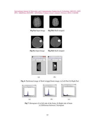 International Journal of Electronics and Communication Engineering & Technology (IJECET), ISSN
0976 – 6464(Print), ISSN 0976 – 6472(Online) Volume 4, Issue 1, January- February (2013), © IAEME




                       Fig 5(a) Input Image      Fig 5(b) Skull stripped




                      Fig 5(c) Input Image       Fig 5(d) Skull stripped




                                  (a)                      (b)

         Fig. 6. Partitioned image of Skull stripped brain image, (a) Left Part (b) Right Part




                    (a)                              (b)                       (c)

               Fig 7. Histogram of (a) left side of the brain, (b) Right side of brain
                                   (c) Difference between 2 histogram




                                               63
 