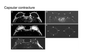 Mri breast (2) | PPTX