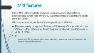 MRI features:
Pelvic MRI is the modality of choice to diagnose and characterise
adenomyosis. Small field of view T2-weighted images (sagittal and axial)
are most useful.
MRI has a sensitivity of 78-88% and specificity of 67-93%
 The most easily recognised feature is thickening of the junctional zone
≥12 mm, either diffusely or focally (normal junctional zone thickness is
up to ~5 mm) .
• T1
• foci of high T1 signal are often seen, indicating menstrual haemorrhage into the
ectopic endometrial tissues
 