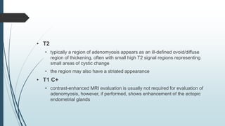 • T2
• typically a region of adenomyosis appears as an ill-defined ovoid/diffuse
region of thickening, often with small high T2 signal regions representing
small areas of cystic change
• the region may also have a striated appearance
• T1 C+
• contrast-enhanced MRI evaluation is usually not required for evaluation of
adenomyosis, however, if performed, shows enhancement of the ectopic
endometrial glands
 