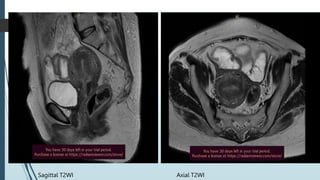 Sagittal T2WI Axial T2WI
 
