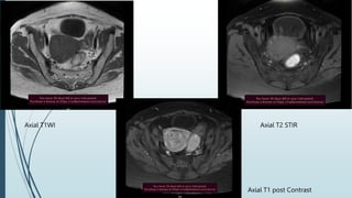 Axial T1WI Axial T2 STIR
Axial T1 post Contrast
 