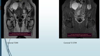 Coronal T2WI Coronal T2 STIR
 