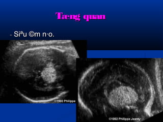 TTæænngg qquuaann 
-- SSiiªuu ©mm nn·oo.. 
 