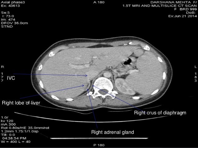 Mri And Ct Of Adrenal Gland