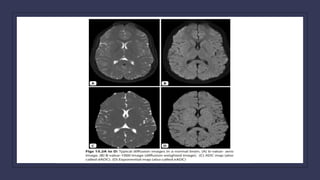 mri diffusion .pptx