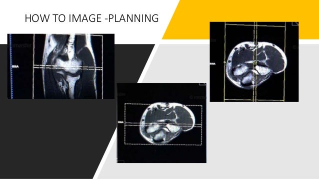 Image result for MRI ELBOW PLANNING