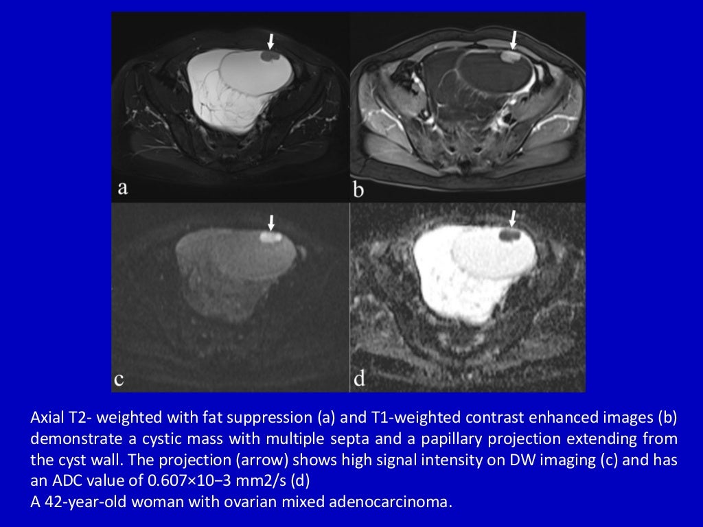 Current Update On Malignant Epithelial Ovarian Tumors – GSJWXX