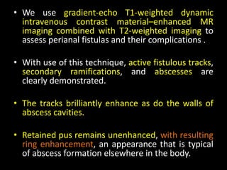 • We use gradient-echo T1-weighted dynamic
intravenous contrast material–enhanced MR
imaging combined with T2-weighted imaging to
assess perianal fistulas and their complications .
• With use of this technique, active fistulous tracks,
secondary ramifications, and abscesses are
clearly demonstrated.
• The tracks brilliantly enhance as do the walls of
abscess cavities.
• Retained pus remains unenhanced, with resulting
ring enhancement, an appearance that is typical
of abscess formation elsewhere in the body.
 