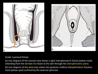 Grade 1 perianal fistula.
(a) Line diagram of the coronal view shows a right intersphincteric fistula (yellow track)
extending from the dentate line down to the skin through the intersphincteric plane.
(b) Line diagram of the axial view shows the posterior midline intersphincteric fistulous
track (yellow spot) confined by the external sphincter.
 