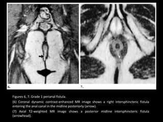 Figures 6, 7. Grade 1 perianal fistula.
(6) Coronal dynamic contrast-enhanced MR image shows a right intersphincteric fistula
entering the anal canal in the midline posteriorly (arrow).
(7) Axial T2-weighted MR image shows a posterior midline intersphincteric fistula
(arrowhead).
 