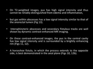 • On T2-weighted images, pus has high signal intensity and thus
cannot be reliably distinguished from edema and inflammation,
• but gas within abscesses has a low signal intensity similar to that of
the anorectal lumen (Fig 13).
• Intersphincteric abscesses and secondary fistulous tracks are well
shown by dynamic contrast-enhanced MR imaging.
• On these contrast-enhanced images, the pus in the central cavity
has low signal intensity and is surrounded by a brightly enhancing
rim (Figs 11, 12).
• A horseshoe fistula, in which the process extends to the opposite
side, is best demonstrated in the axial plane (Figs 10, 12b).
 