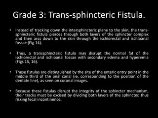 Grade 3: Trans-sphincteric Fistula.
• Instead of tracking down the intersphincteric plane to the skin, the trans-
sphincteric fistula pierces through both layers of the sphincter complex
and then arcs down to the skin through the ischiorectal and ischioanal
fossae (Fig 14).
• Thus, a transsphincteric fistula may disrupt the normal fat of the
ischiorectal and ischioanal fossae with secondary edema and hyperemia
(Figs 15, 16).
• These fistulas are distinguished by the site of the enteric entry point in the
middle third of the anal canal (ie, corresponding to the position of the
dentate line), as seen on coronal images.
• Because these fistulas disrupt the integrity of the sphincter mechanism,
their tracks must be excised by dividing both layers of the sphincter, thus
risking fecal incontinence.
 