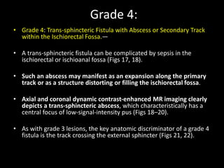 Grade 4:
• Grade 4: Trans-sphincteric Fistula with Abscess or Secondary Track
within the Ischiorectal Fossa.—
• A trans-sphincteric fistula can be complicated by sepsis in the
ischiorectal or ischioanal fossa (Figs 17, 18).
• Such an abscess may manifest as an expansion along the primary
track or as a structure distorting or filling the ischiorectal fossa.
• Axial and coronal dynamic contrast-enhanced MR imaging clearly
depicts a trans-sphincteric abscess, which characteristically has a
central focus of low-signal-intensity pus (Figs 18–20).
• As with grade 3 lesions, the key anatomic discriminator of a grade 4
fistula is the track crossing the external sphincter (Figs 21, 22).
 