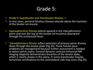 Grade 5:
• Grade 5: Supralevator and Translevator Disease.—
• In rare cases, perianal fistulous disease extends above the insertion
of the levator ani muscle.
• Suprasphincteric fistulas extend upward in the intersphincteric
plane and over the top of the levator ani to pierce downward
through the ischiorectal fossa.
• Extrasphincteric fistulas reflect extension of primary pelvic disease
down through the levator plate (Fig 23). These fistulas pose
problems for management because further assessment is needed
to detect pelvic sepsis. Coronal dynamic contrast-enhanced MR
imaging elegantly demonstrates breaches of the levator plate,
which is clearly shown in this plane. In some translevator fistulas,
horseshoe ramifications to the contralateral side may occur (Fig 24).
 