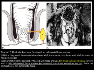 Figures 17, 18. Grade 4 perianal fistula with an ischiorectal fossa abscess.
(17) Line diagram of the coronal view shows a left trans-sphincteric fistula with a left ischiorectal
fossa abscess (a).
(18) Coronal dynamic contrast-enhanced MR image shows a left trans-sphincteric fistula (arrow)
with a left ischiorectal fossa abscess (arrowheads) containing nonenhancing pus. Note the
contraction of the ischiorectal fossa.
 