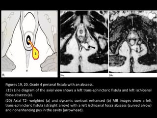Figures 19, 20. Grade 4 perianal fistula with an abscess.
(19) Line diagram of the axial view shows a left trans-sphincteric fistula and left ischioanal
fossa abscess (a).
(20) Axial T2- weighted (a) and dynamic contrast enhanced (b) MR images show a left
trans-sphincteric fistula (straight arrow) with a left ischioanal fossa abscess (curved arrow)
and nonenhancing pus in the cavity (arrowhead).
 