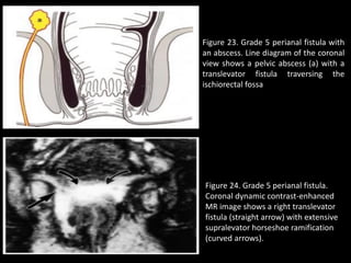 Figure 23. Grade 5 perianal fistula with
an abscess. Line diagram of the coronal
view shows a pelvic abscess (a) with a
translevator fistula traversing the
ischiorectal fossa
Figure 24. Grade 5 perianal fistula.
Coronal dynamic contrast-enhanced
MR image shows a right translevator
fistula (straight arrow) with extensive
supralevator horseshoe ramification
(curved arrows).
 