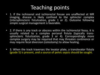 Teaching points
• 1. If the ischioanal and ischiorectal fossae are unaffected at MR
imaging, disease is likely confined to the sphincter complex
(intersphincteric fistulization, grade 1 or 2). Outcome following
simple surgical management is favorable.
• 2. If there is any track or abscess within the ischiorectal fossa, it is
usually related to a complex perianal fistula (typically trans-
sphincteric fistulization, grade 3 or 4). Correspondingly more
complex surgery may be required that may threaten continence or
may require fecal diversion (colostomy) to allow healing.
• 3. When the track traverses the levator plate, a translevator fistula
(grade 5) is present, and a source of pelvic sepsis should be sought.
 