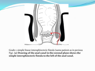 Mri for identifying types of fistulae | PPTX