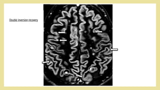 MRI for Physiotherapy | PDF