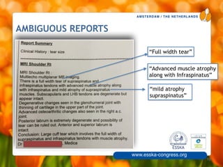 AMSTERDAM / THE NETHERLANDS
www.esska-congress.org
AMBIGUOUS REPORTS
10
“Full width tear”
“Advanced muscle atrophy 
along with Infraspinatus”
“mild atrophy
supraspinatus”
 
