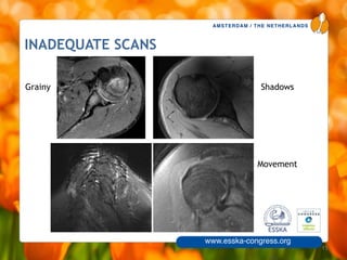 AMSTERDAM / THE NETHERLANDS
www.esska-congress.org
INADEQUATE SCANS
15
Grainy Shadows
Movement
 