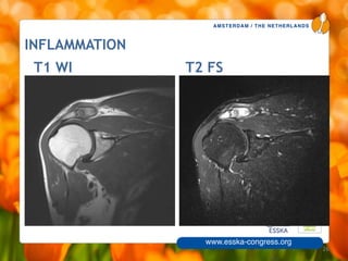 AMSTERDAM / THE NETHERLANDS
www.esska-congress.org
26
T1 WI T2 FS
INFLAMMATION
 