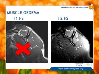 AMSTERDAM / THE NETHERLANDS
www.esska-congress.org
MUSCLE OEDEMA
27
T1 FS T2 FS
 