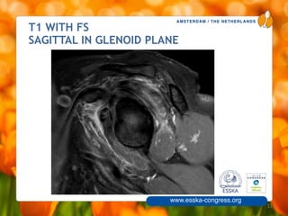 AMSTERDAM / THE NETHERLANDS
www.esska-congress.org
T1 WITH FS
SAGITTAL IN GLENOID PLANE
33
 