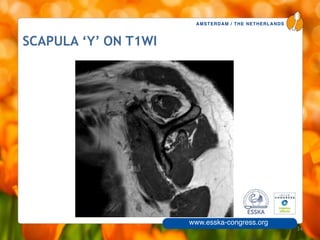 AMSTERDAM / THE NETHERLANDS
www.esska-congress.org
SCAPULA ‘Y’ ON T1WI
34
 