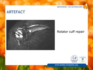 AMSTERDAM / THE NETHERLANDS
www.esska-congress.org
ARTEFACT
• Rotator cuff repair
36
 
