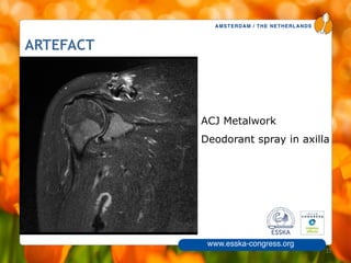 AMSTERDAM / THE NETHERLANDS
www.esska-congress.org
ARTEFACT
• ACJ Metalwork
• Deodorant spray in axilla
37
 