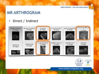 AMSTERDAM / THE NETHERLANDS
www.esska-congress.org
MR ARTHROGRAM
• Direct / Indirect
38
 