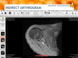 AMSTERDAM / THE NETHERLANDS
www.esska-congress.org
INDIRECT ARTHROGRAM
39
 