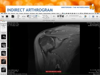 AMSTERDAM / THE NETHERLANDS
www.esska-congress.org
40
INDIRECT ARTHROGRAM
 