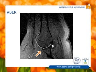 AMSTERDAM / THE NETHERLANDS
www.esska-congress.org
ABER
43
 