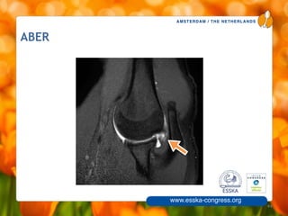 AMSTERDAM / THE NETHERLANDS
www.esska-congress.org
44
ABER
 